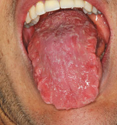 lesions-2-geographic-tongue.jpg